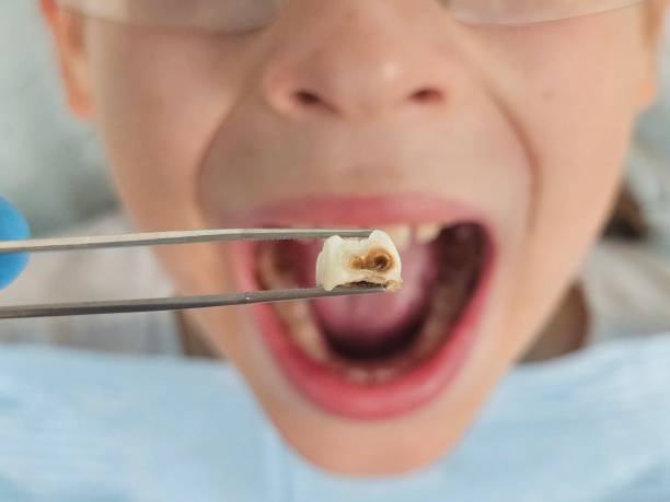 Best Emergency Treatment for Oral Infections in Charlotte Harbor, FL